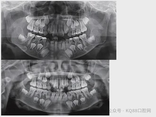 九个月长两颗牙是否正常，婴幼儿牙齿生长解析