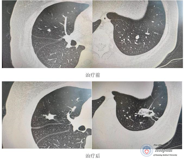 一个月三次CT，探究其必要性及注意事项